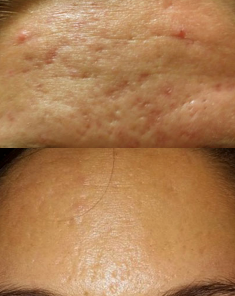 rajeunissement du visage homme