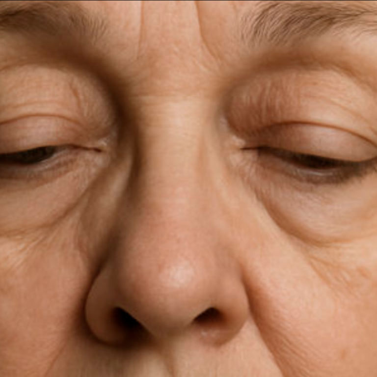 Paupières tombantes