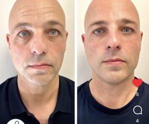 Facial Masculinization